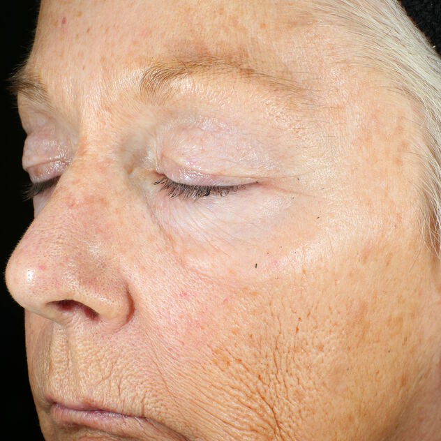 Wrinkle + Texture Repair  before-after-1