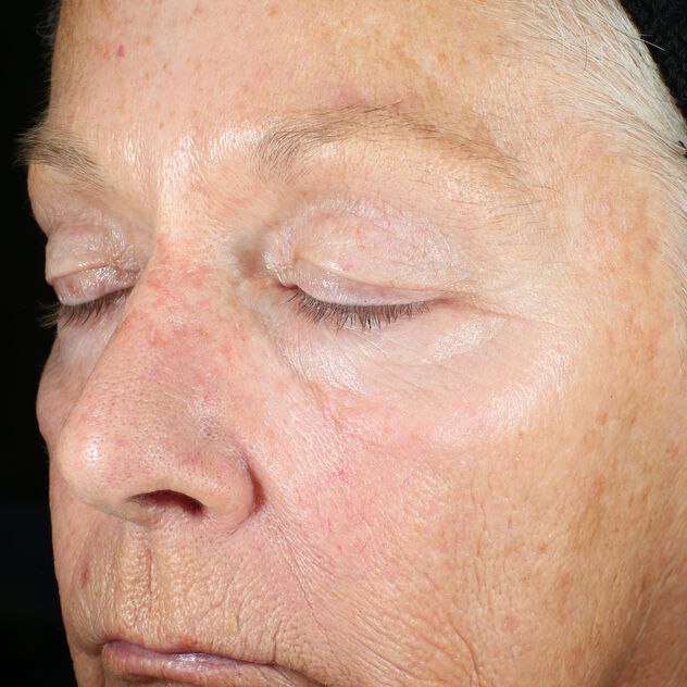 Wrinkle + Texture Repair  before-after-1