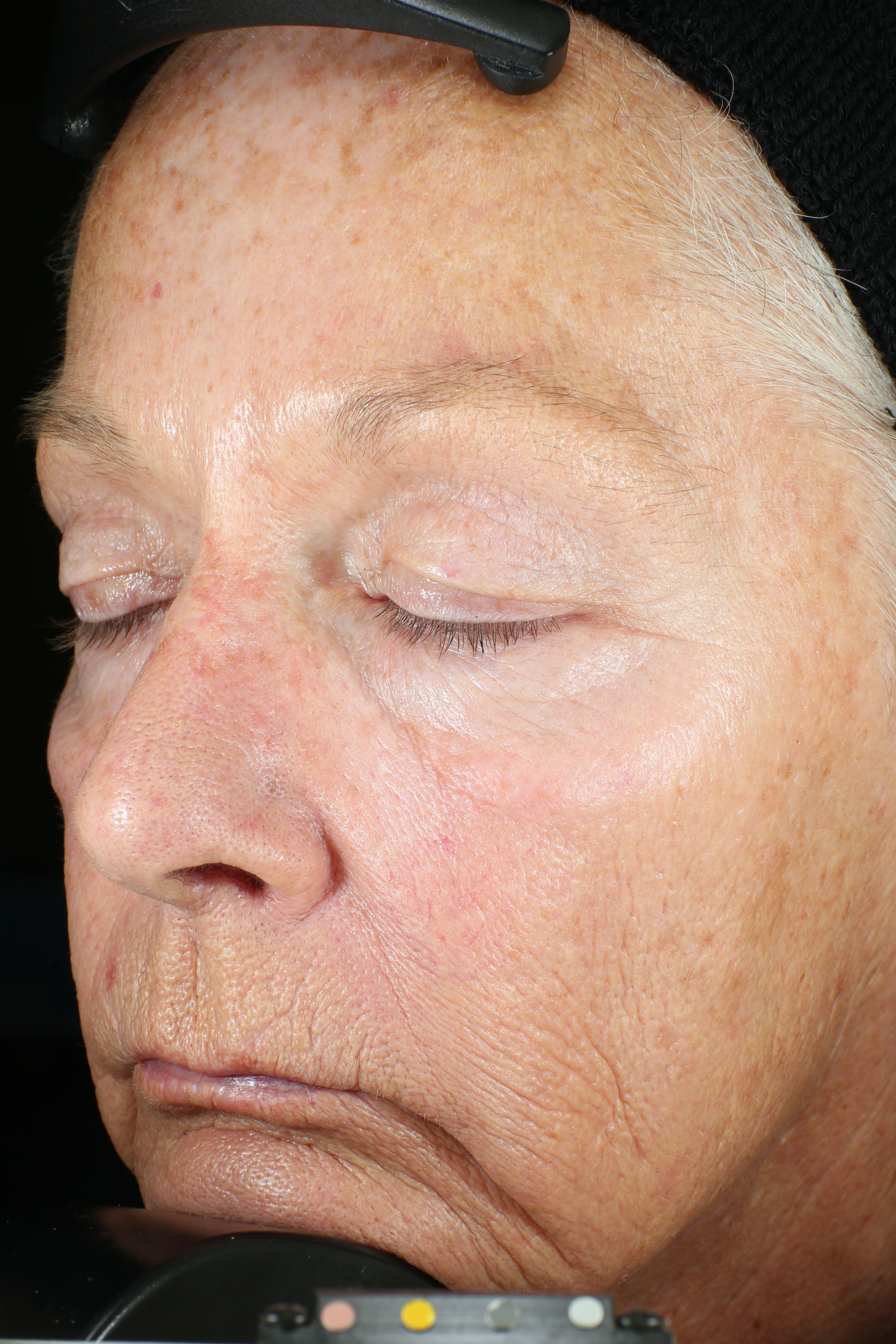 Wrinkle + Texture Repair  before-after-1